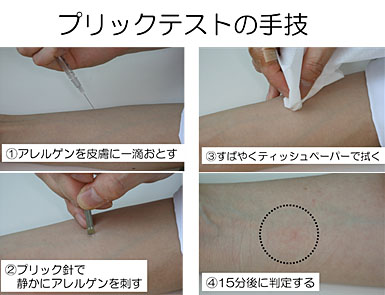 アレルギー検査方法の実際｜一般社団法人日本アレルギー学会